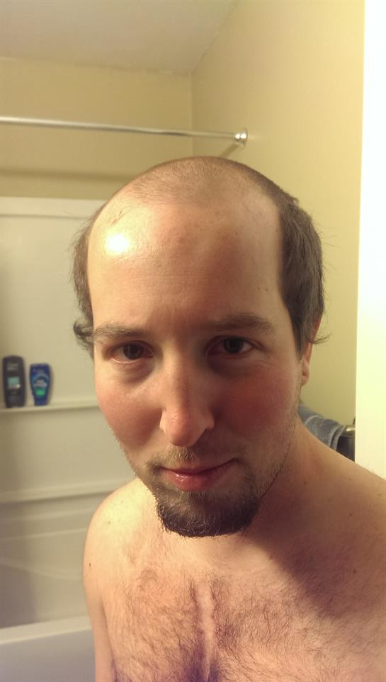 Man showcases an unusual hairstyle with a balding pattern while standing in a bathroom.